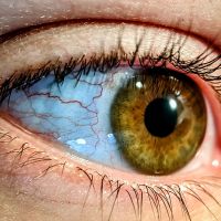 6 березня 2024 року – Всесвітній день боротьби з глаукомою